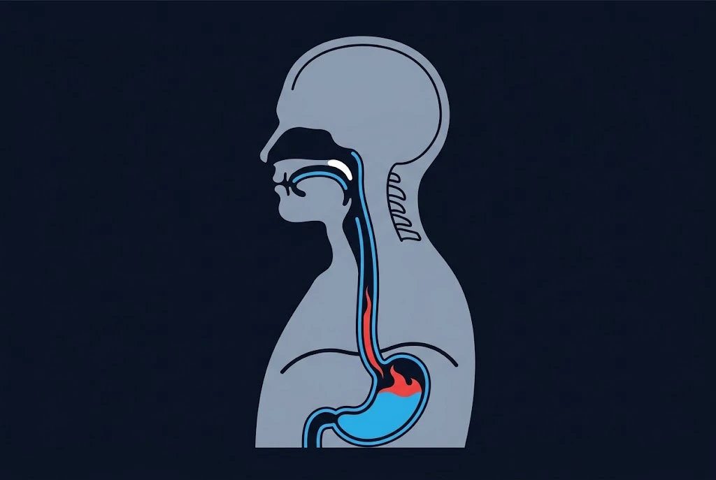 Side-view diagram of the esophagus and stomach with acid rising up the esophagus, showing how acid reflux causes heartburn
